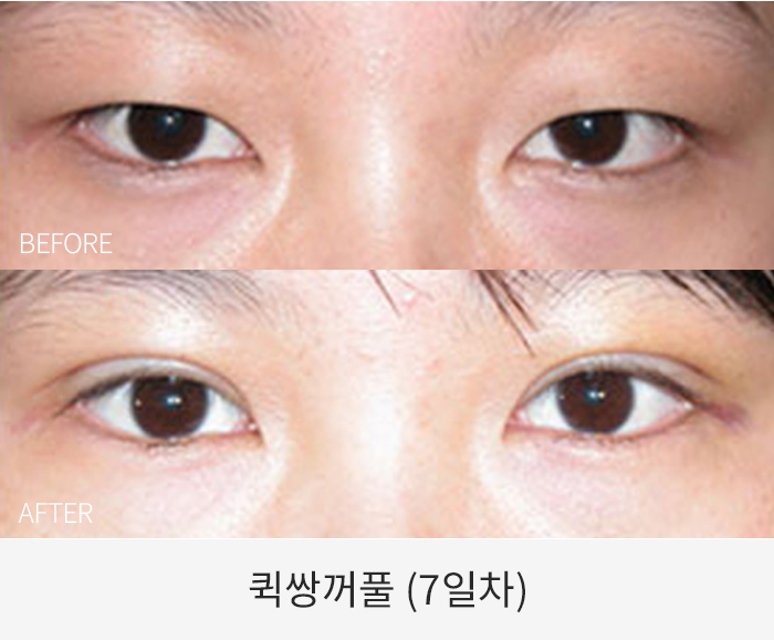 퀵쌍꺼풀