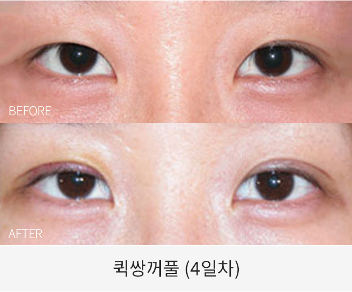퀵쌍꺼풀