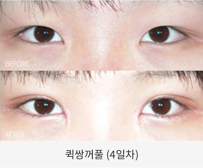 퀵쌍꺼풀
