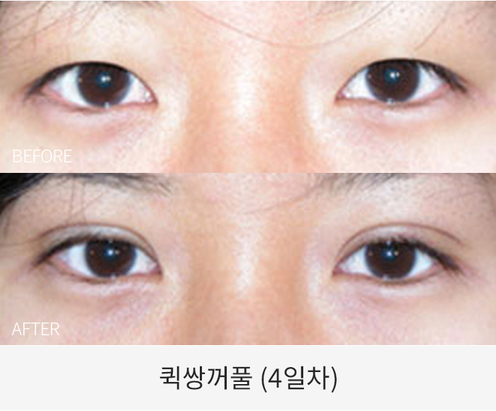 퀵쌍꺼풀