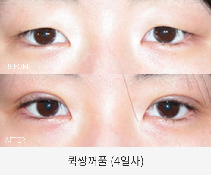퀵쌍꺼풀