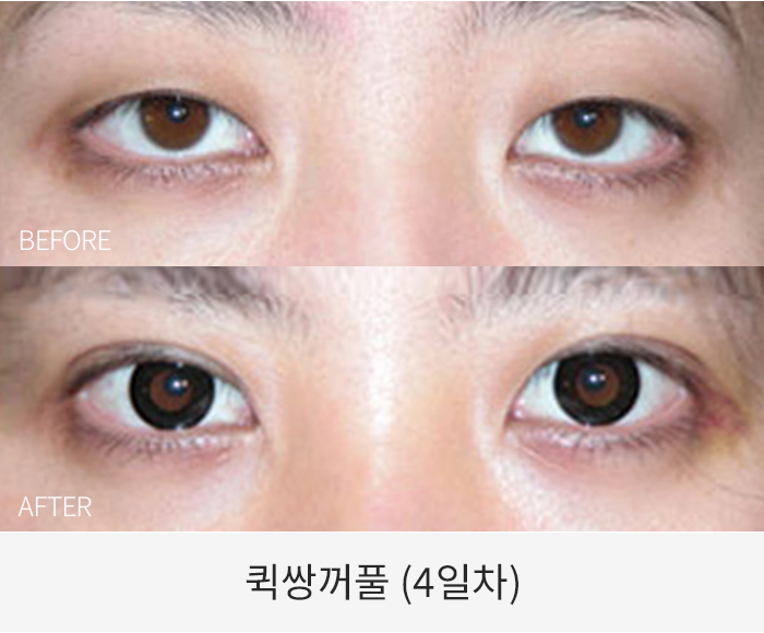 퀵쌍꺼풀