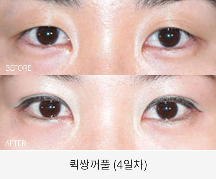 퀵쌍꺼풀