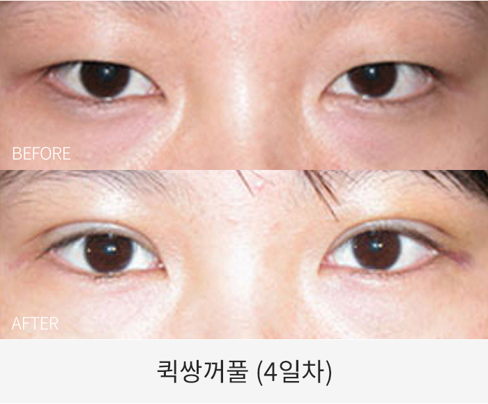 퀵쌍꺼풀