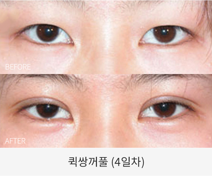 퀵쌍꺼풀