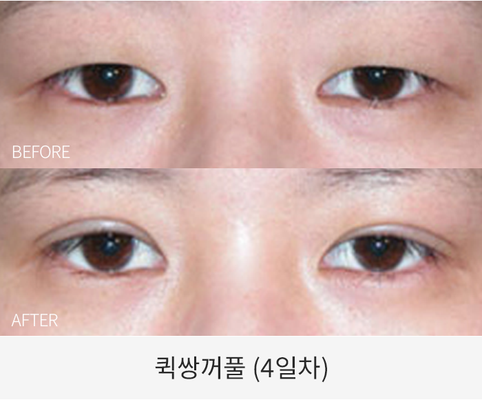 퀵쌍꺼풀