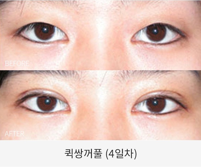 퀵쌍꺼풀