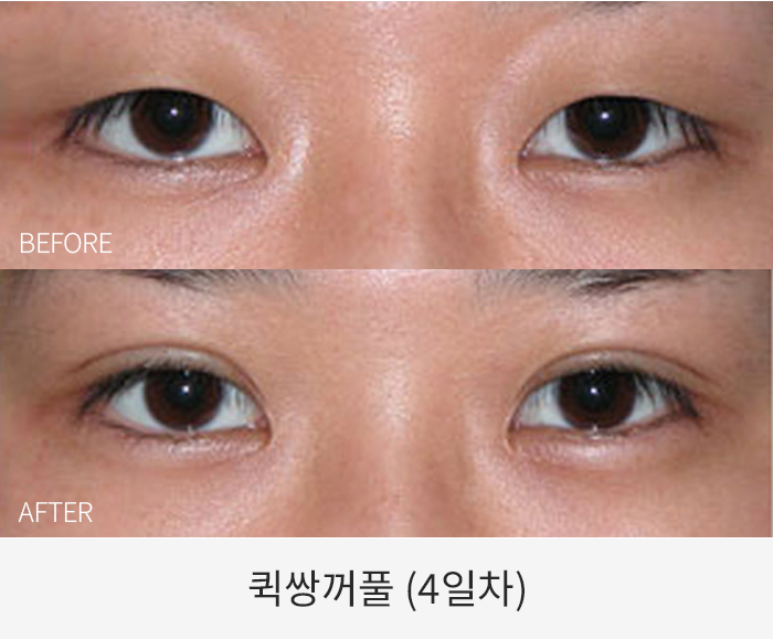 퀵쌍꺼풀