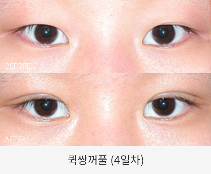 퀵쌍꺼풀