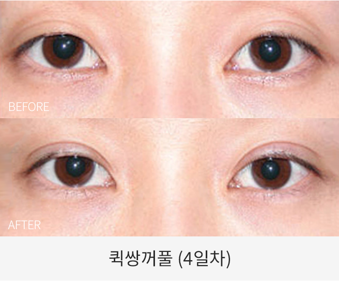 퀵쌍꺼풀