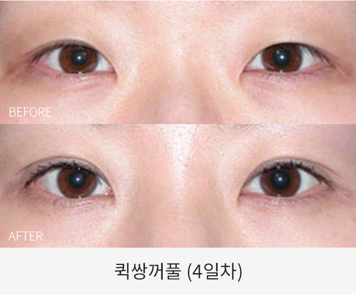 퀵쌍꺼풀
