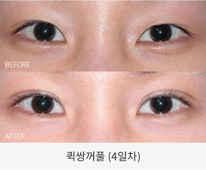 퀵쌍꺼풀
